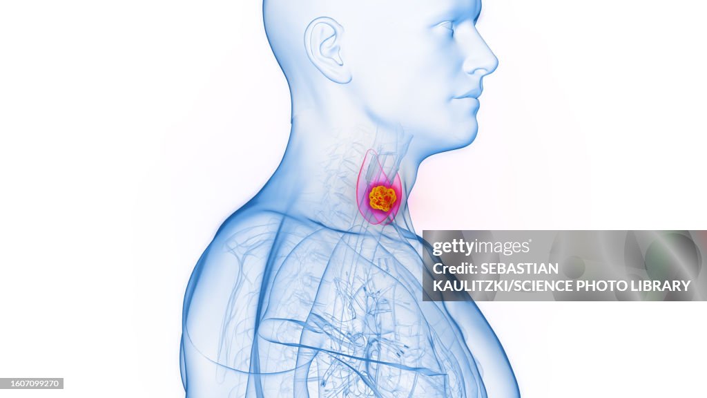 Thyroid cancer, illustration