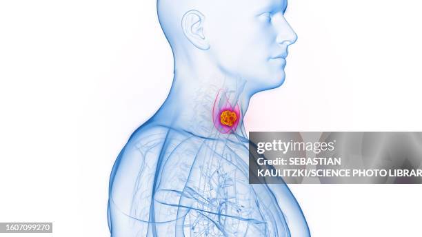 thyroid cancer, illustration - follicular thyroid cancer stock illustrations