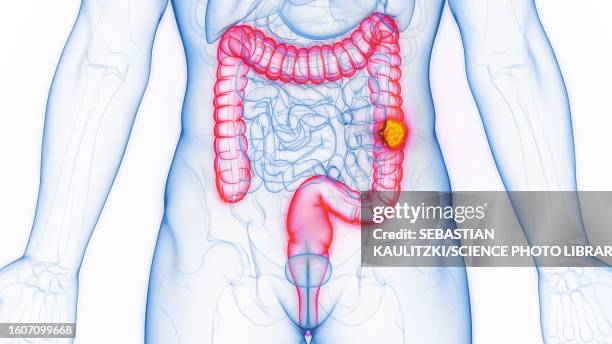 colon cancer, illustration - human colon stock illustrations