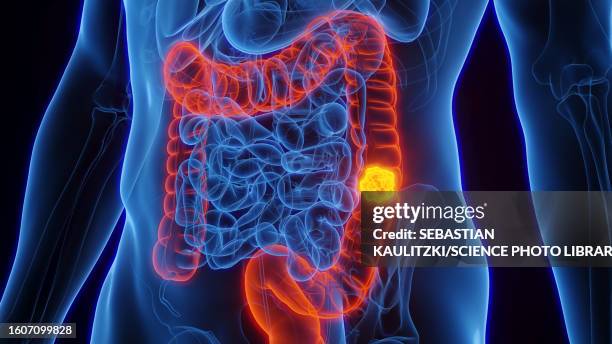ilustraciones, imágenes clip art, dibujos animados e iconos de stock de colon cancer, illustration - cancer colorrectal
