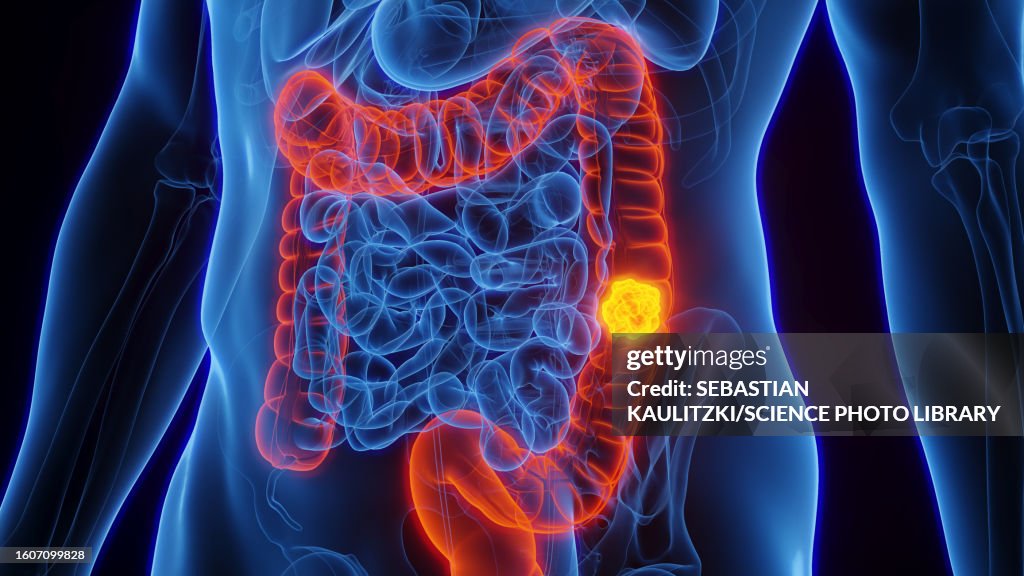 Colon cancer, illustration
