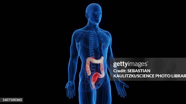 inflamed colon, illustration - inflammatory bowel disease stock illustrations