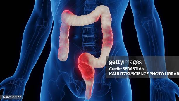 ilustrações de stock, clip art, desenhos animados e ícones de inflamed colon, illustration - inflamação