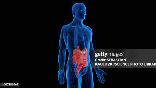 intestines affected by crohn's disease, illustration - ulcerative colitis stock illustrations