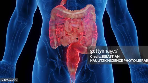 intestines affected by crohn's disease, illustration - moving down stock illustrations