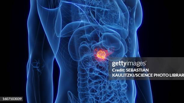 pancreatic cancer, illustration - pancreatic cancer stock illustrations