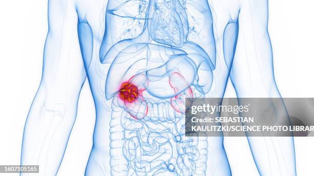 ilustraciones, imágenes clip art, dibujos animados e iconos de stock de kidney cancer, illustration - carcinoma renal