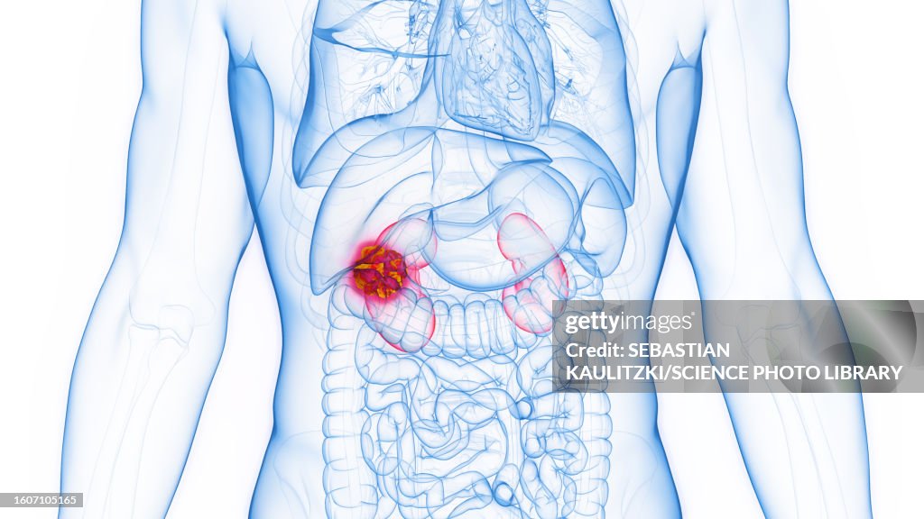 Kidney cancer, illustration