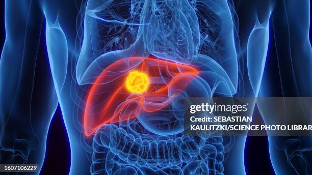 liver cancer, illustration - cancer illness stock illustrations