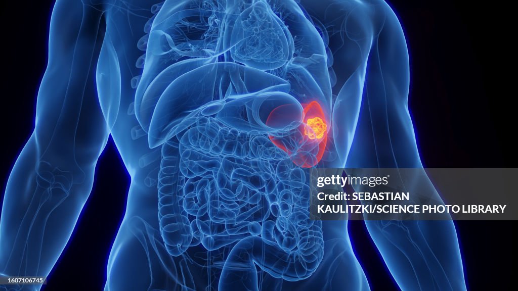 Splenic cancer, illustration