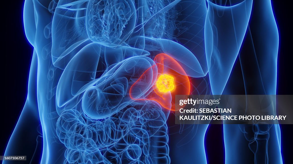 Splenic cancer, illustration