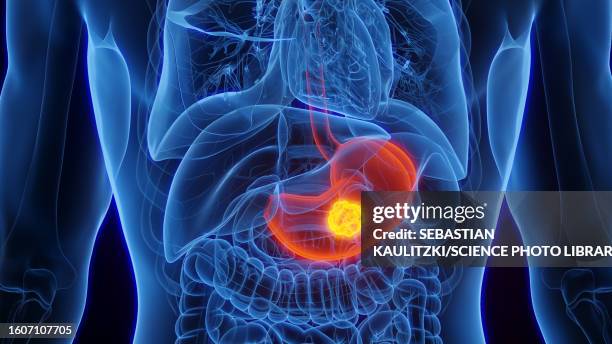 illustrazioni stock, clip art, cartoni animati e icone di tendenza di stomach cancer, illustration - stomaco