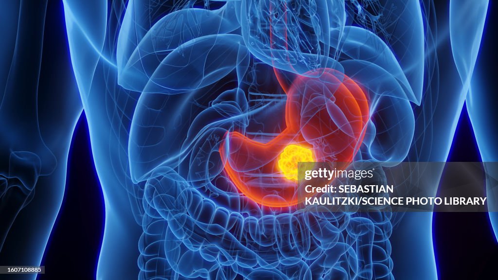 Stomach Cancer Illustration High-Res Vector Graphic - Getty Images