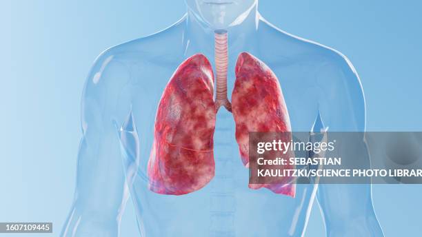 inflamed lungs, illustration - cystic fibrosis 幅插畫檔、美工圖案、卡通及圖標