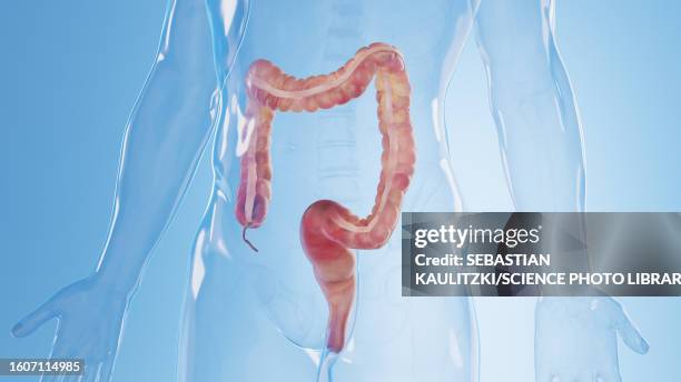 inflamed colon, illustration - ulcerative colitis stock illustrations