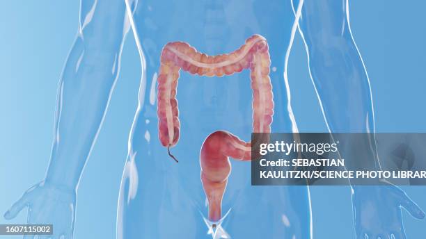 inflamed colon, illustration - ulcerative colitis stock illustrations