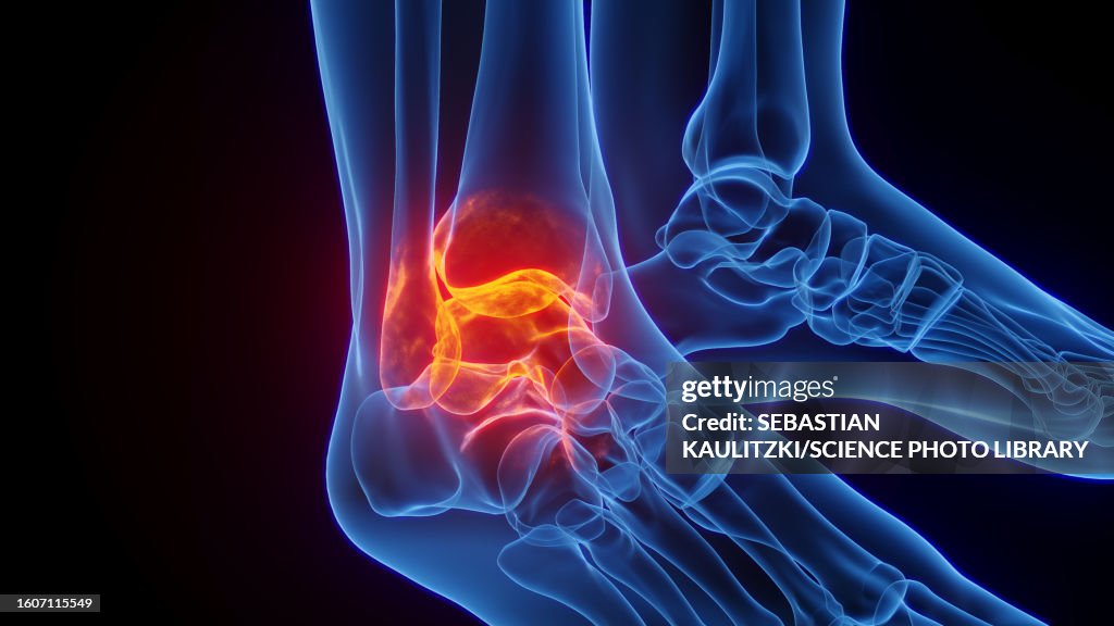 Inflamed ankle, illustration