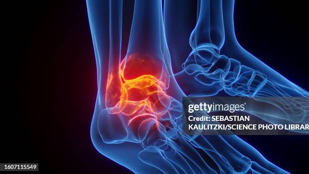 inflamed ankle, illustration - ankle sprain stock illustrations