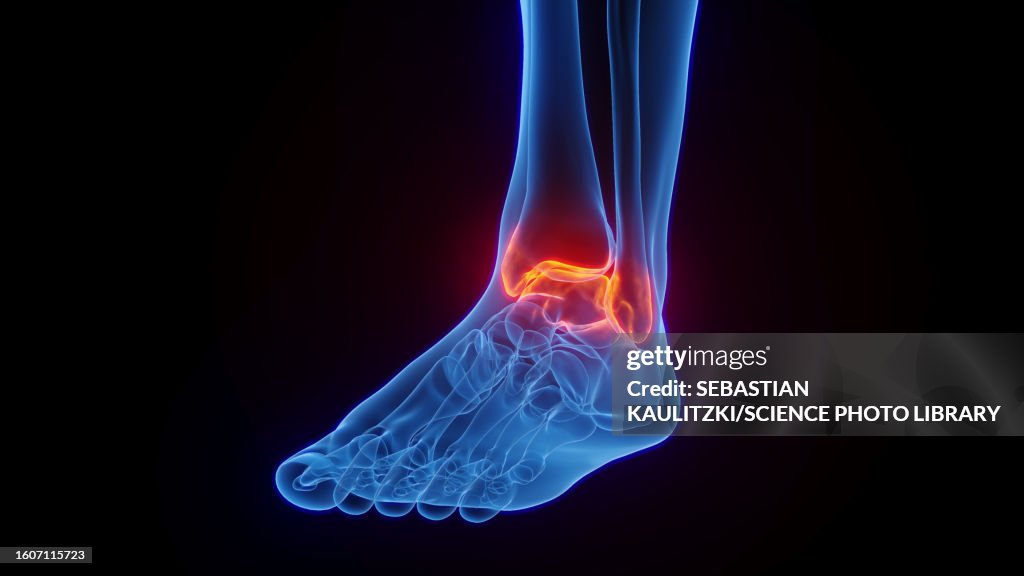 Inflamed Ankle Illustration High-Res Vector Graphic - Getty Images