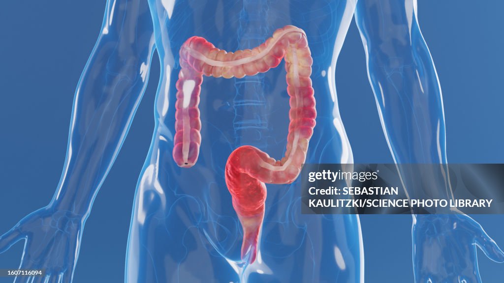 Inflamed colon, illustration