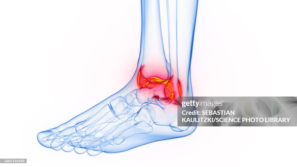 Inflamed Ankle Illustration High-Res Vector Graphic - Getty Images
