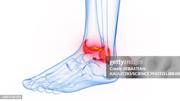 inflamed ankle, illustration - ankle sprain stock illustrations