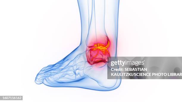 inflamed ankle, illustration - ankle sprain stock illustrations