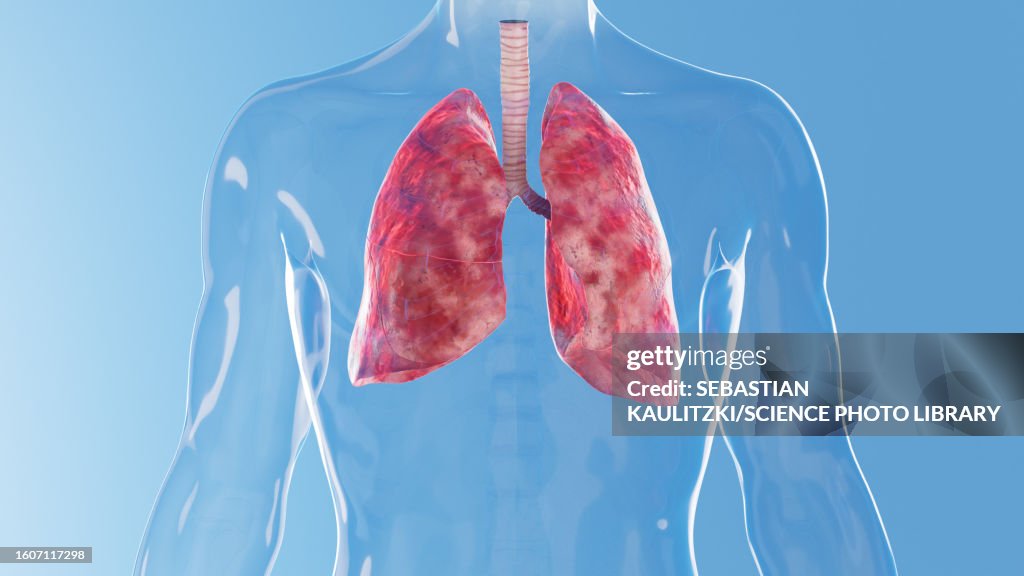 Inflamd Inflamed Lungs Illustration High-Res Vector Graphic - Getty Images