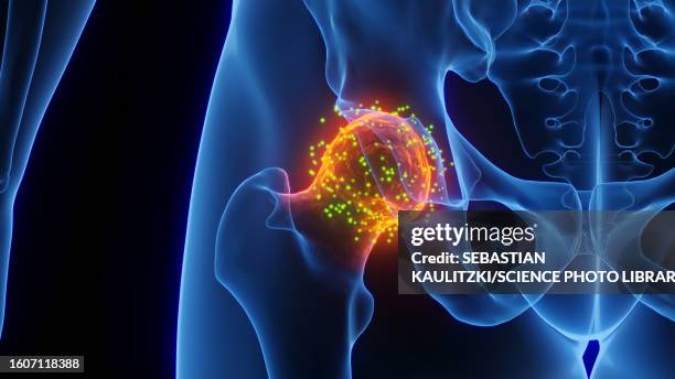 inflamed hip joint healing, illustration - gelenkrheumatismus stock-grafiken, -clipart, -cartoons und -symbole