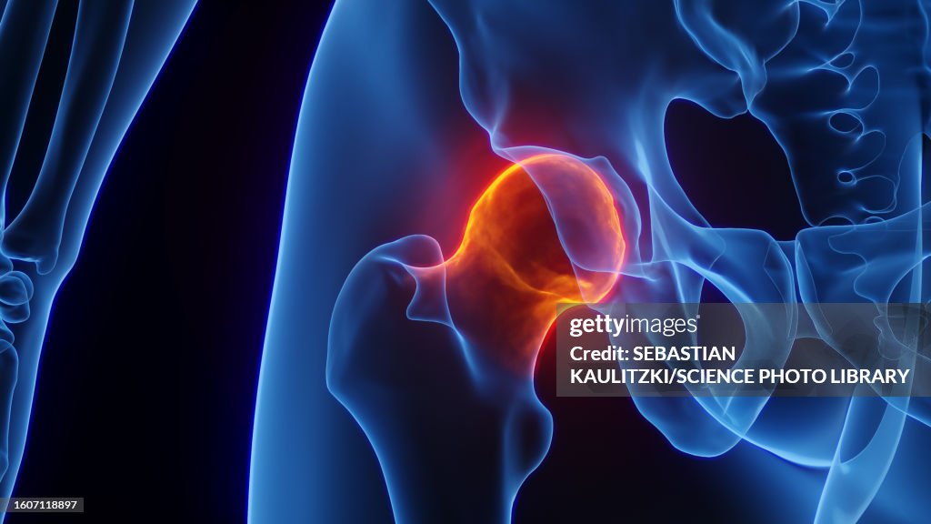 Inflamed Hip Joint Illustration High-Res Vector Graphic - Getty Images
