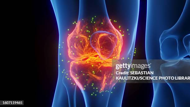 stockillustraties, clipart, cartoons en iconen met inflamed knee healing, illustration - gout