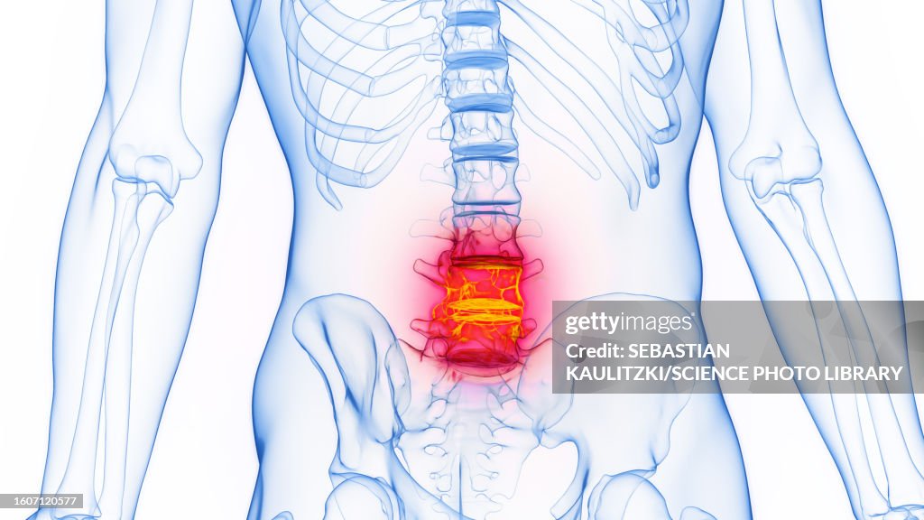 Inflamed Lumbar Spine Illustration High-Res Vector Graphic - Getty Images