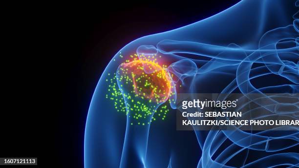 inflamed shoulder joint healing, illustration - rheumatismus stock-grafiken, -clipart, -cartoons und -symbole