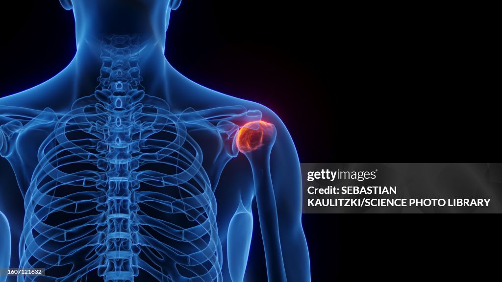 Inflamed shoulder joint, illustration