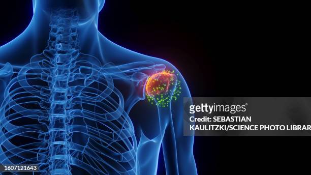inflamed shoulder joint healing, illustration - shoulder joint stockfoto's en -beelden