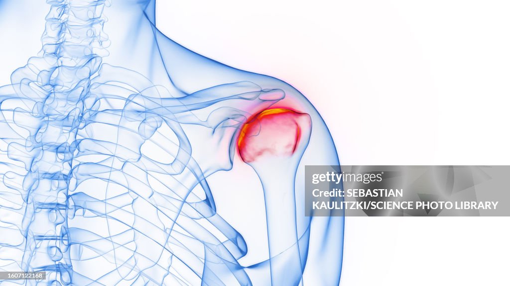 Inflamed shoulder joint, illustration