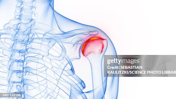 ilustrações, clipart, desenhos animados e ícones de inflamed shoulder joint, illustration - omoplata