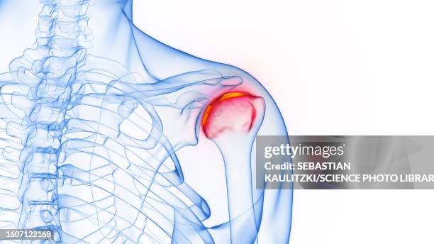 inflamed shoulder joint, illustration - shoulder pain stock illustrations