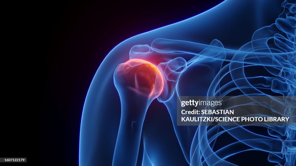 Inflamed Shoulder Joint Illustration High-Res Vector Graphic - Getty Images