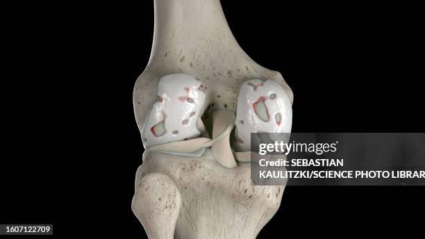 damaged knee cartilage, illustration - rheumatism 幅插畫檔、美工圖案、卡通及圖標