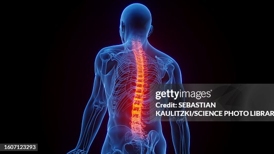 Inflamed spine, illustration Inflamed spine, illustration