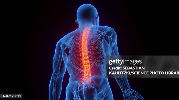 ilustraciones, imágenes clip art, dibujos animados e iconos de stock de inflamed spine, illustration - espondilitis anquilosante