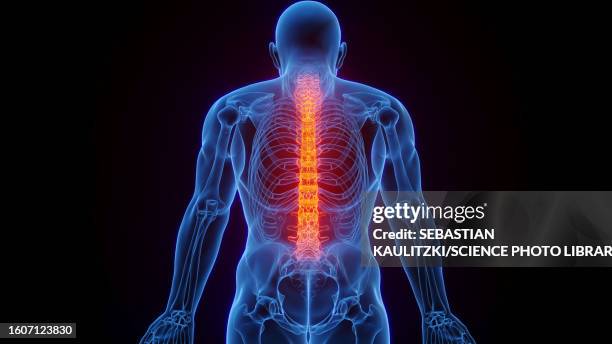 stockillustraties, clipart, cartoons en iconen met inflamed spine, illustration - spier
