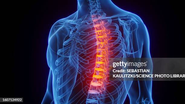 ilustraciones, imágenes clip art, dibujos animados e iconos de stock de inflamed thoracic spine, illustration - espondilitis anquilosante