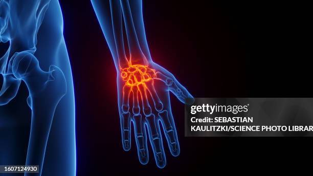 inflamed wrist, illustration - handgelenk stock-grafiken, -clipart, -cartoons und -symbole
