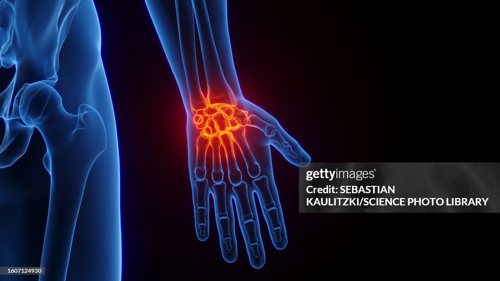 Inflamed wrist, illustration