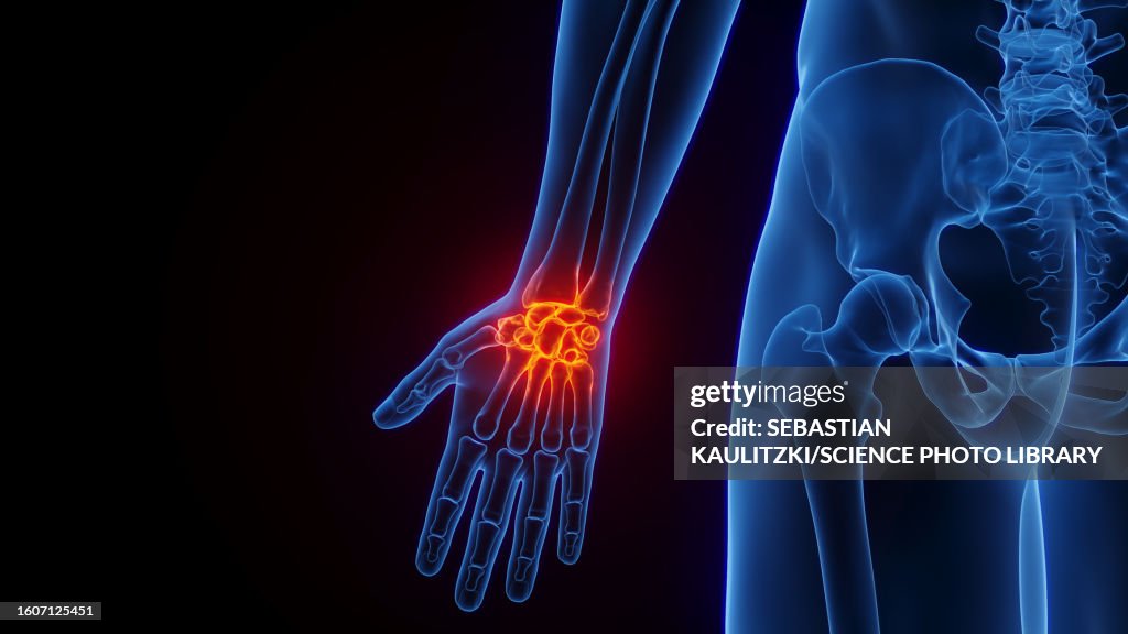 Inflamed wrist, illustration