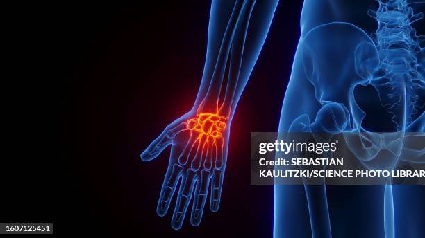 inflamed wrist, illustration - carpal tunnel syndrome stock illustrations
