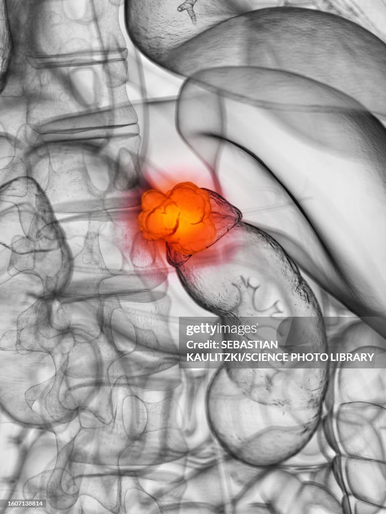 Adrenal gland cancer, illustration