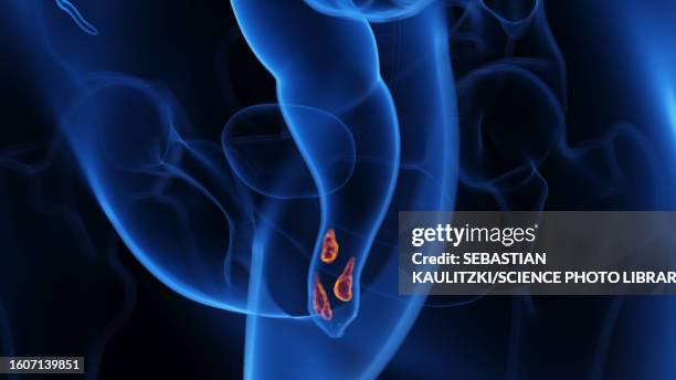 haemorrhoids, illustration - hemorrhoid treatment stock illustrations